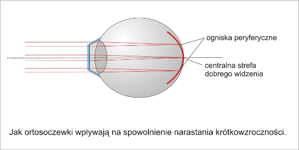 jak_ortosoczewki_koryguja_krotkowzrocznosc