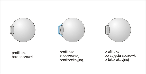 ortosoczewki_3